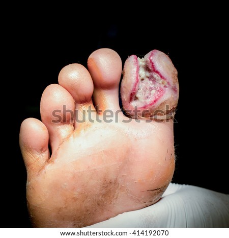 Wound Diabetic Foot Infraction Gangrene Stock Photo (Edit Now