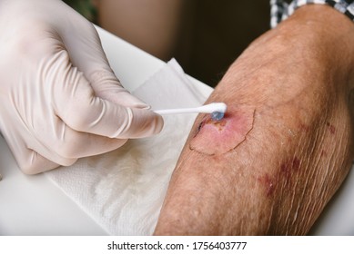 Wound Dressing, Doctor Applying Medicine To Infected Wound In Chronic Diabetes Senior Patient, Accidental Wound Care Treatment In Elderly Old Man.