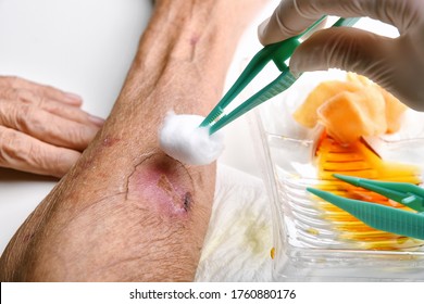 Wound Dressing, Doctor Cleaning And Wash Infected Wound In Chronic Diabetes Senior Patient With Normal Saline And Povidone Iodine, Accidental Wound Care Treatment In Elderly Old Man.