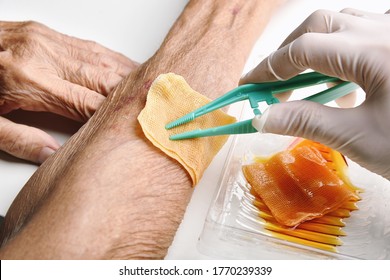 Wound Dressing, Doctor Cleaning And Wash Infected Wound In Chronic Senior Diabetes Patient With Normal Saline And Povidone Iodine, Accidental Wound Care Treatment In Elder Old Man.