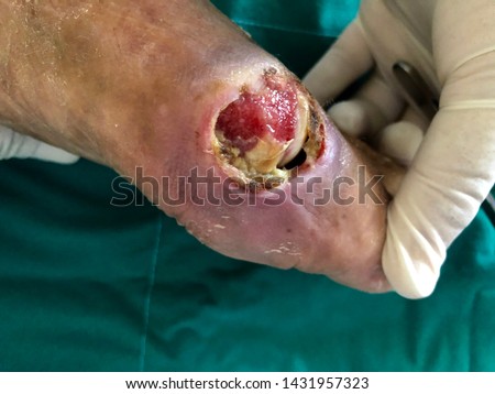 Wound and Dressing wound with infected wound diabetic foot disease. Medical and healthcare concept