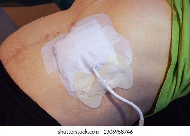 Wound Dressing Of A VAD-driveline