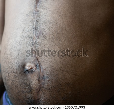 Wound from explorative surgery following gunshot wound to the abdomen.