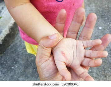 Wound In The Hand Of A Child From An Iron Burn In Father's Hand