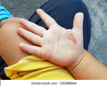 Wound In The Hand Of A Child From An Iron Burn