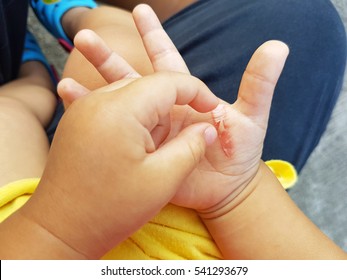 Wound In The Hand Of A Child From An Iron Burn