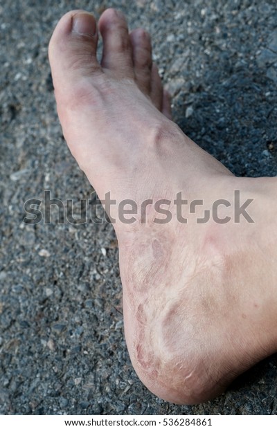 The wound healed in foot from the accident.\
Treatment methods skin\
graft.