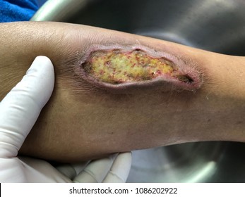 Wound with infected wound diabetic foot disease and burn wound from hot water, Medical and healthcare concept.