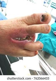 Wound Infection, Post Amputation Right Third Toe 