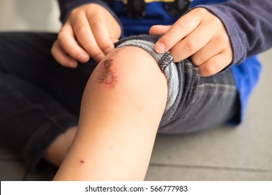 Wound On The Knee Of A Small Child