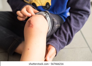 Wound On The Knee Of A Small Child