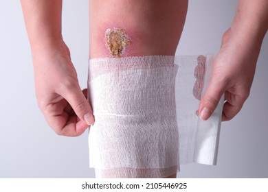 Wound On The Knee, A Woman Independently Bandages Her Leg With A Bandage