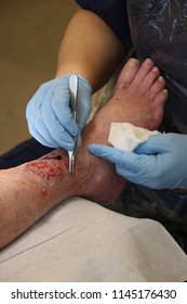 Wound on the leg the nurse cleaning