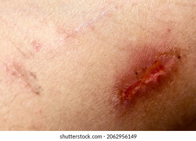 Wound on the skin of a man's leg, scratch skin injury from accident.