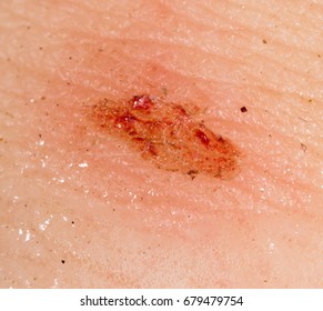 Wound On Skin Person Stock Photo 687162658 | Shutterstock