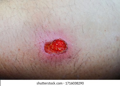 Wound Scab Injury On Leg Skin.