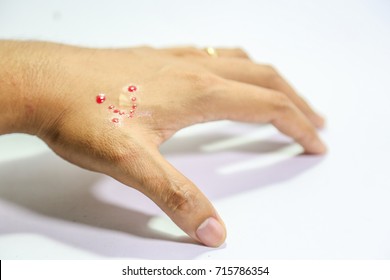 Snake Bite High Res Stock Images Shutterstock