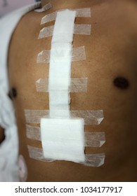 Wound sternum with dry dressing is health of wound patient operation surgical .
