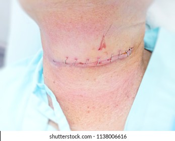 Wound Stitches Neck ,Surgery On The Throat, Neck ,Throat ,Larynx Surgery,