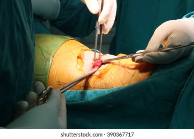 Wound Suture 