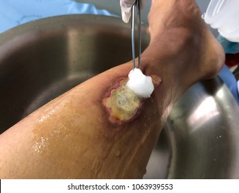 Wound,Dressing wound with infected wound diabetic foot disease from hot water. Medical and healthcare concept.