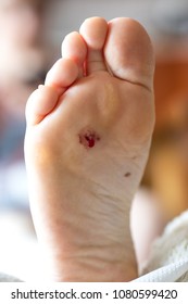 Wounded Female Foot. A Wound From The Nail That Pierced The Shoe. Light Background.