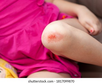 Wounded Knee Of The Child, Abrasions On The Baby Girl's Knees.