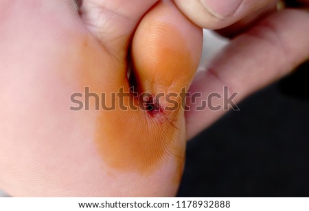 Wounds caused by a sharp stab at the foot articulated finger joints. A hole deep and wide