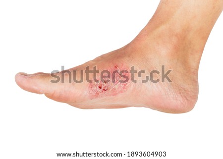 Wounds and dry skin on human foot. Eczema skin of patient. Ulcers and infection of medical concepts.