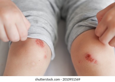 Wounds On The Knees Of A Child, Damaged Skin On The Legs. Falling Injury. First Aid.