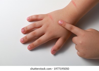 Wounds And Scar On A Child Hand Hand Close Up. Physical Child Abuse.