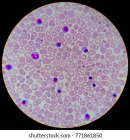 Wright Stained Peripheral Blood Smear Before A And After B