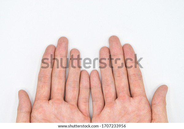 Wrinkled or dry and rough hands and fingers\
of Southeast asian adult young man because of hand washing with\
methylated spirit. Dryness or fissures of hands and fingers.\
Isolated on white\
background.