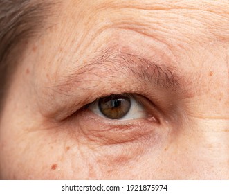 Wrinkles Around The Eyes On A Woman's Face