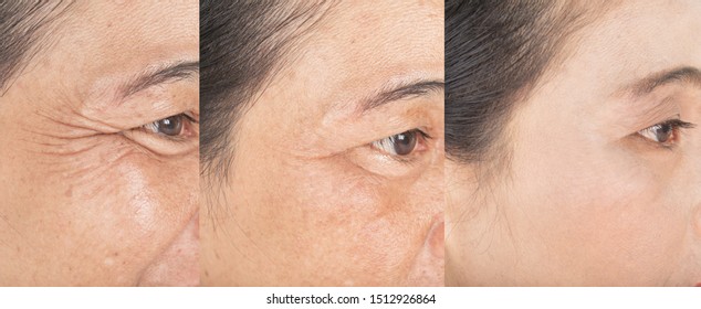 Wrinkles On The Eyes.  And Before And After Melasma  And Freckles  Facial Treatment On Face  Skin Problem And  Make-up In Women
