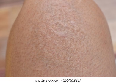 腕の小さな白い斑点 特発性ゲンマ病 老人の皮膚の肝斑点 によく似た画像 写真素材 ベクター画像 Shutterstock