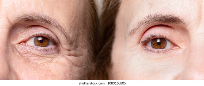 Wrinkles Under Eye Before And After Botox Treatment
