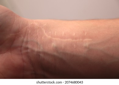 Wrist Surgery Scar Carpal Tunnel Syndrome On A Caucasian Female Person