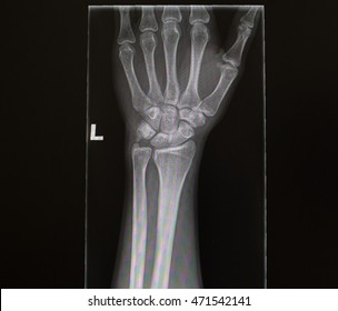 Wrist Xray Anterior Posterior View