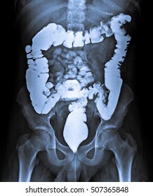 X Ray Of Abdomen With Contrast Medium