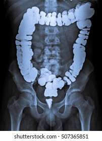 X Ray Of Abdomen With Contrast Medium In Large Intestine.