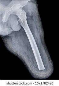 X -ray With Amputation Of The Thigh