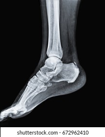 X Ray Of Ankle Joint Of Human Leg.