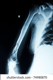 X Ray  Broken Arm