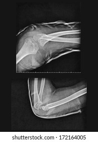 X Ray Broken Arm Humerus Fracture Foto stock 172164005 | Shutterstock