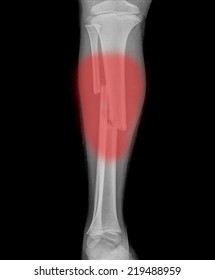 x ray Broken leg