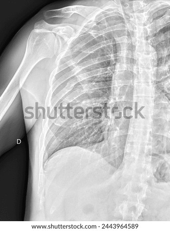 x ray of broken ribs torax close up still