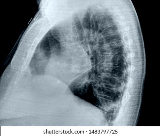 X -ray Of The Chest With Cardiomegaly