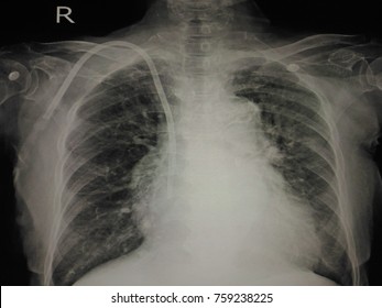 X- Ray Chest Showing Central Venous Dialysis Catheter,Image Blurry And Too Soft.World Kidney Day Concepts.