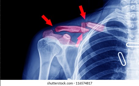 X- ray of collarbone